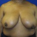 PATIENT 115 Before