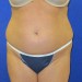 PATIENT 116 Before - 2