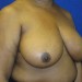 PATIENT 115 Before - 2