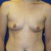 PATIENT 124 Before