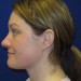 PATIENT 125 Before - 2