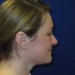 PATIENT 125 Before - 3