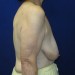 PATIENT 128 Before - 3