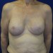 PATIENT 128 After