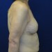 PATIENT 128 After - 3
