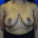 PATIENT 137 After