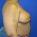 PATIENT 115 After - 3