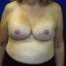 PATIENT 141 After