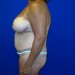 PATIENT 147 Before - 3