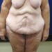 PATIENT 153 Before