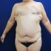 PATIENT 161 Before