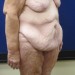 PATIENT 153 Before - 2