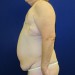 PATIENT 161 Before - 3