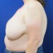 PATIENT 157 Before - 3