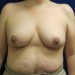 PATIENT 157 After