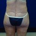 PATIENT 153 After - 4
