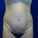 PATIENT 165 Before - 3