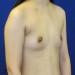 PATIENT 166 Before - 2