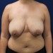 PATIENT 171 Before