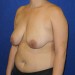 PATIENT 171 Before - 2