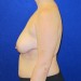 PATIENT 171 Before - 3