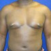 PATIENT183 Before
