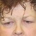 PATIENT 181 Before