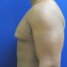 PATIENT183 Before - 2