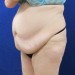 PATIENT 189 Before - 2