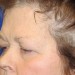 PATIENT 181 Before - 2