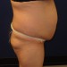 PATIENT 174 Before - 2