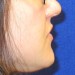 PATIENT 188 B Before - 3