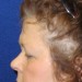 PATIENT 181 Before - 3