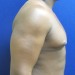 PATIENT183 Before - 3