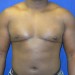 PATIENT183 After