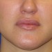 PATIENT 188 B After