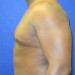 PATIENT183 After - 2