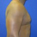 PATIENT183 After - 3