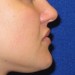 PATIENT 188 B After - 3