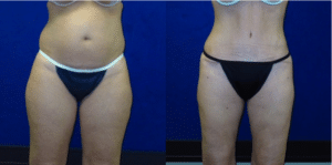 Before and After Liposuction