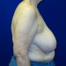 PATIENT 194 Before - 3