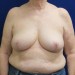 PATIENT 194 After