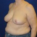 PATIENT 194 After - 2