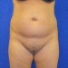 PATIENT 197 Before - 4