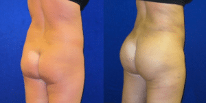 Before and After Brazilian Butt Lift