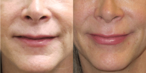 Before and After JUVÉDERM®