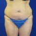 PATIENT 198 Before - 4