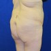 PATIENT 198 Before - 2