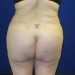PATIENT 198 After - 3