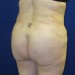 PATIENT 198 After - 2